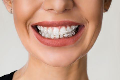Brackets estéticos