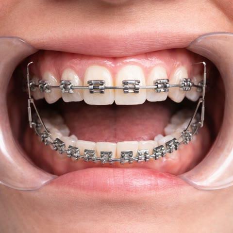 Brackets metálicos