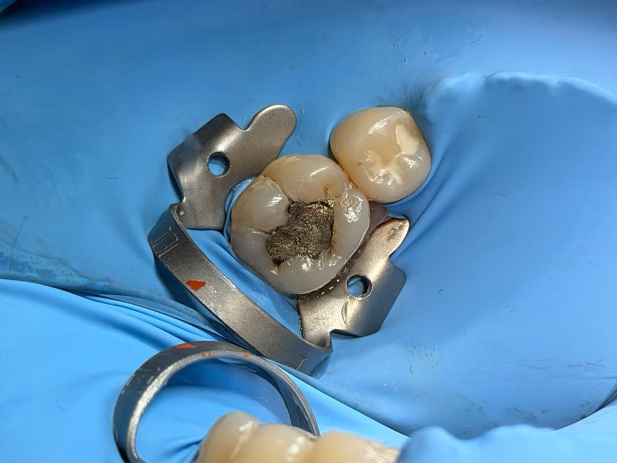 Curación dental — antes