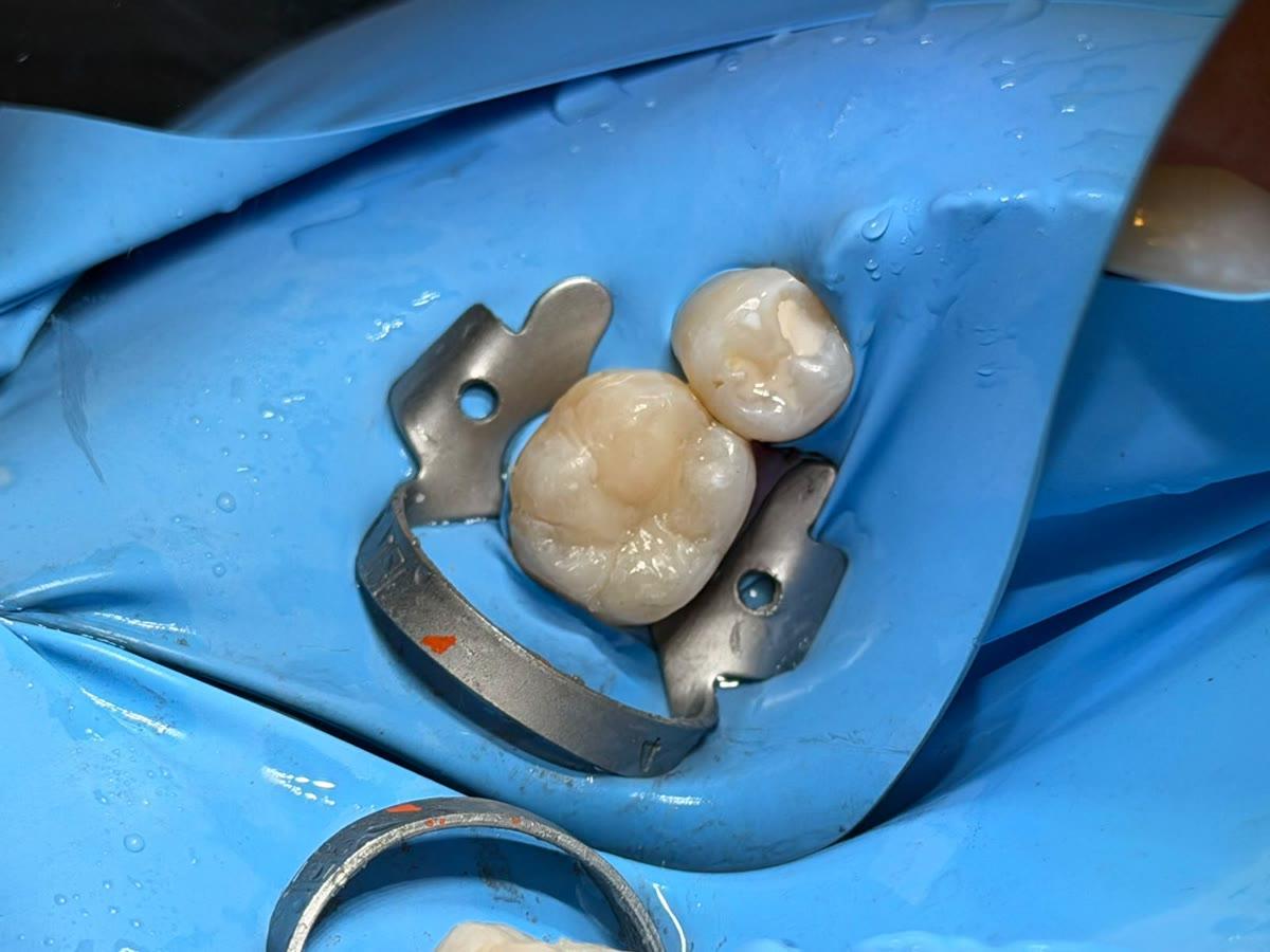 Curación dental — después