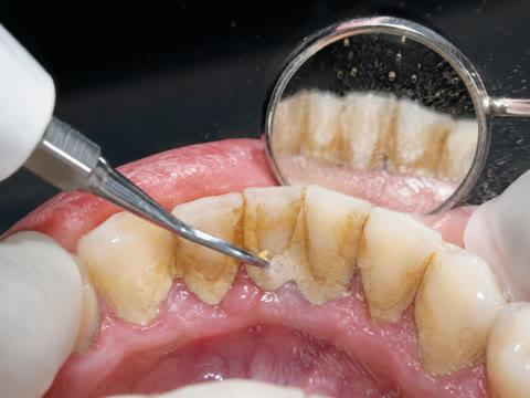 Limpieza dental