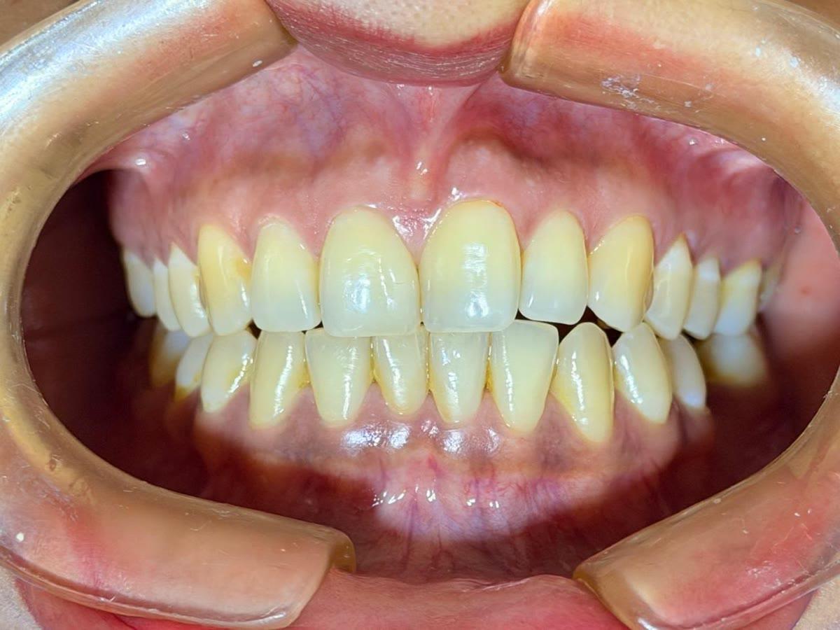 Limpieza integral y blanqueamiento — antes
